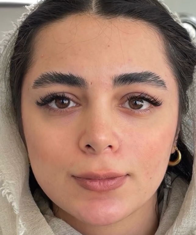 فیلر گونه - قبل